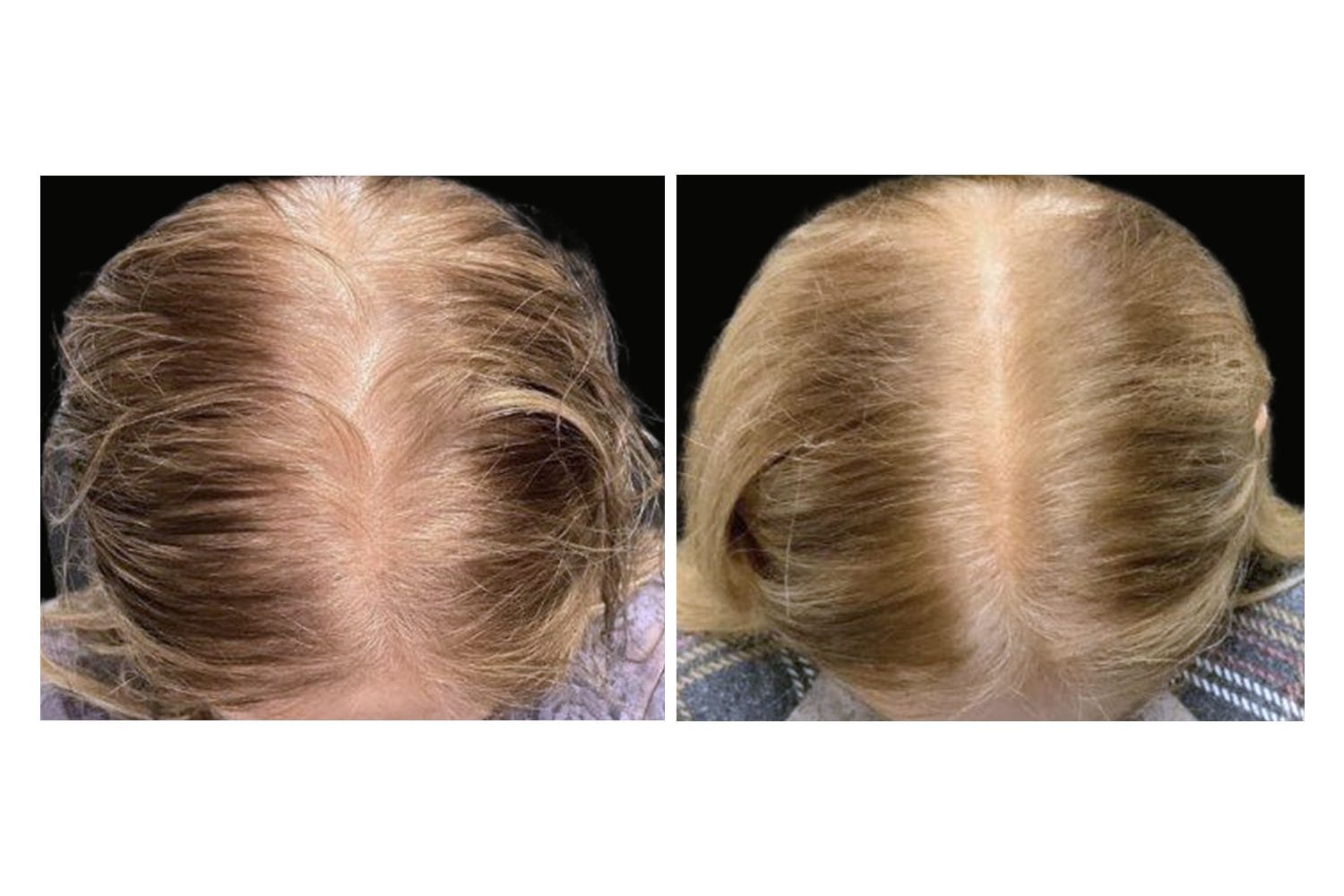 AquaFirmeXS & DE|RIVE before and after &middot; Scalp / hair