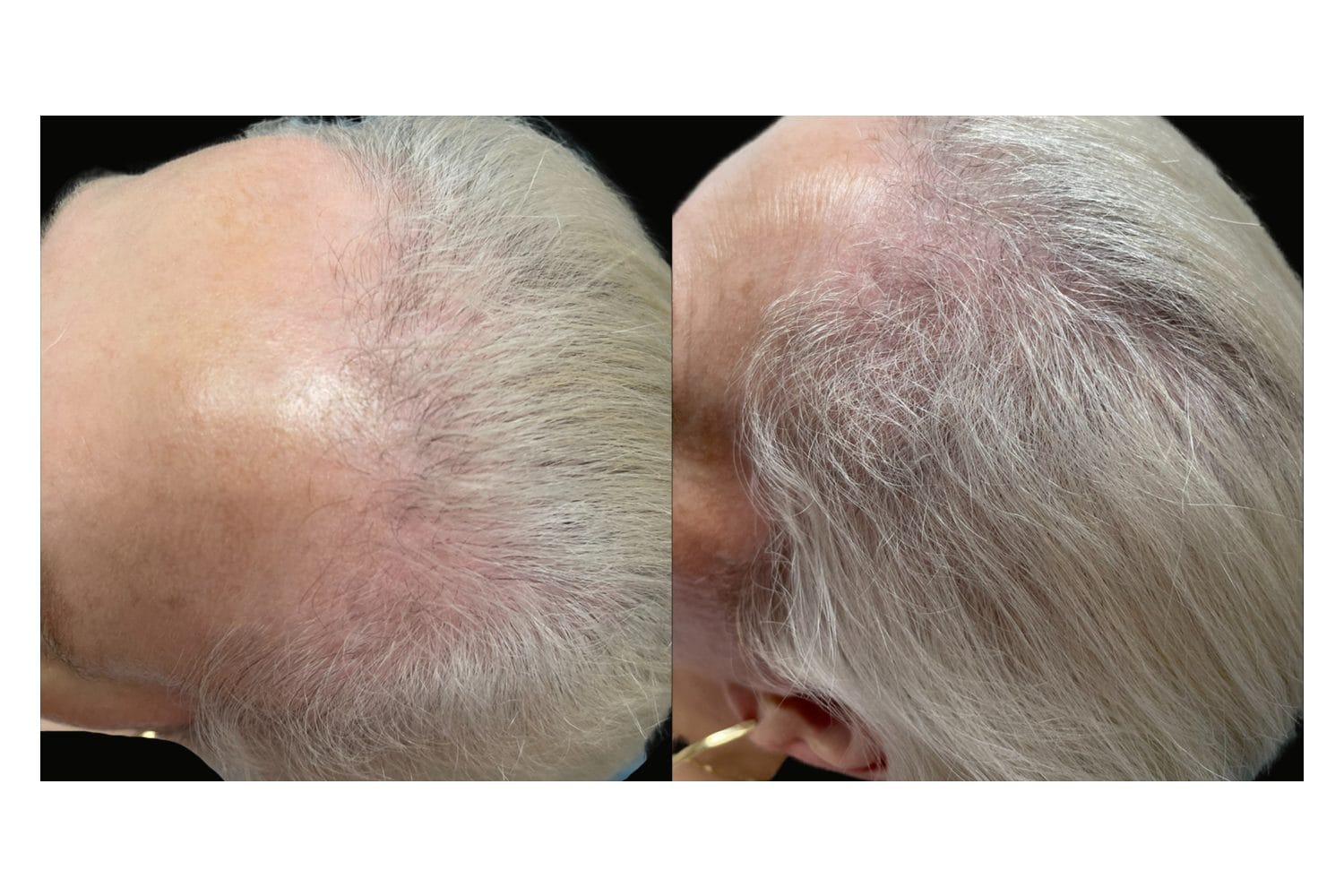 AquaFirmeXS & DE|RIVE before and after &middot; Scalp / hair