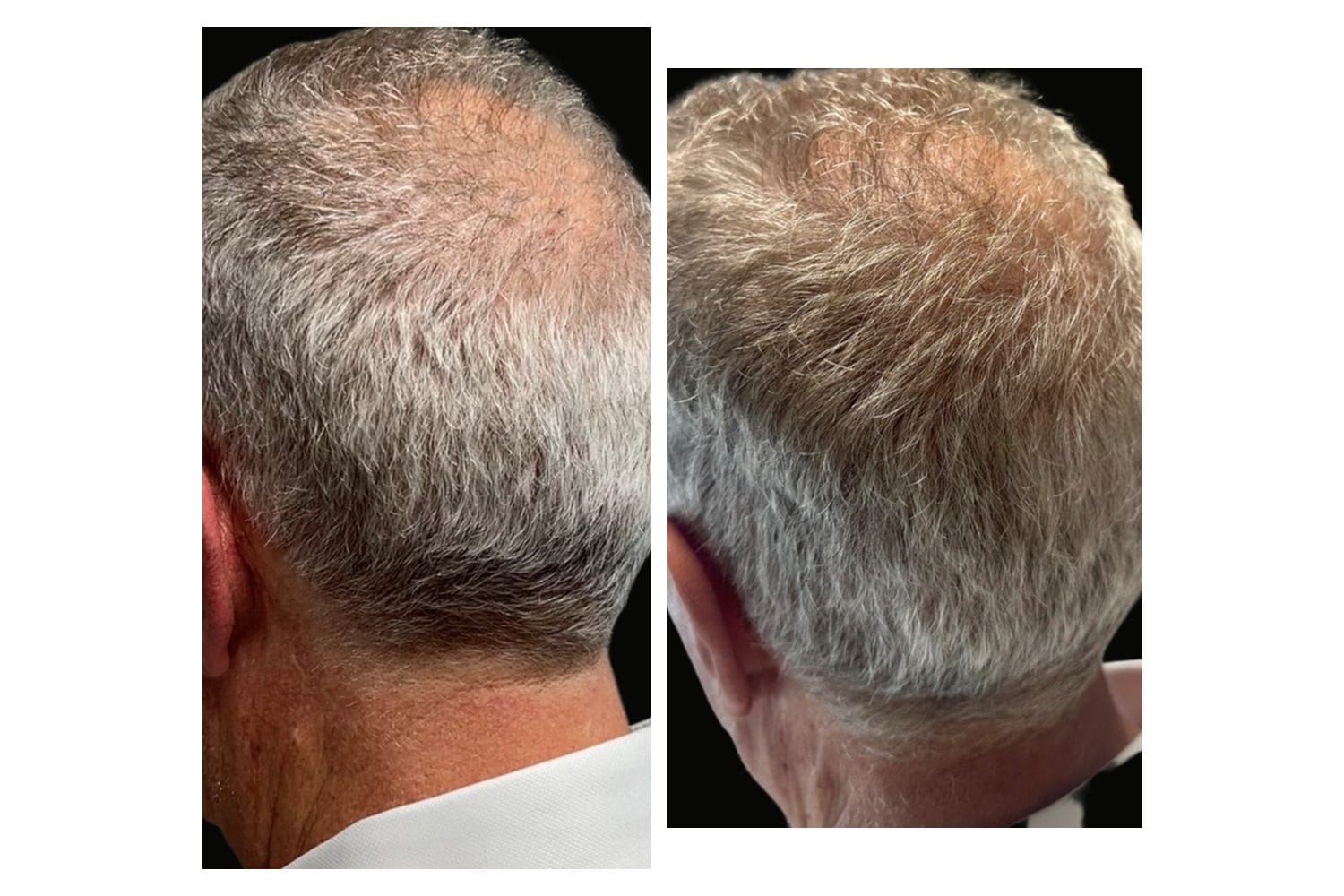 AquaFirmeXS & DE|RIVE before and after &middot; Scalp / hair