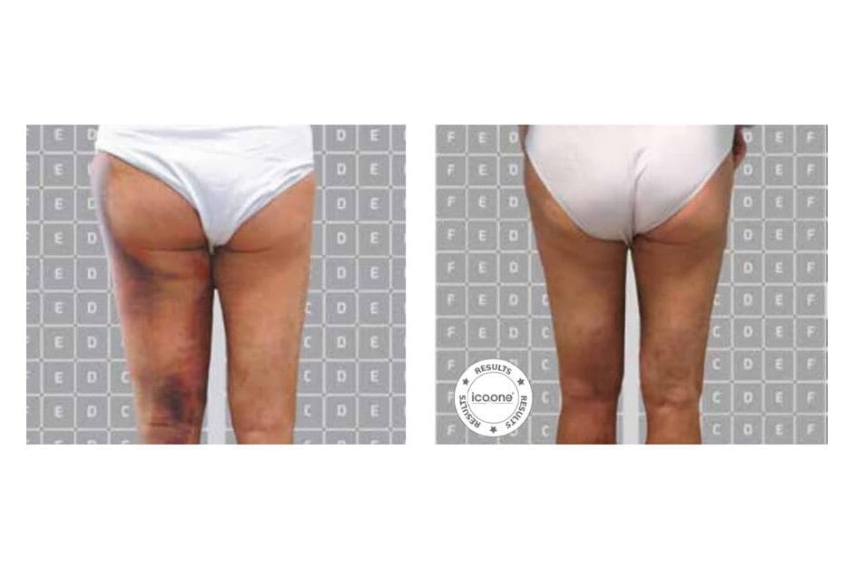 ICOONE before and after &middot; Post-surgical recovery