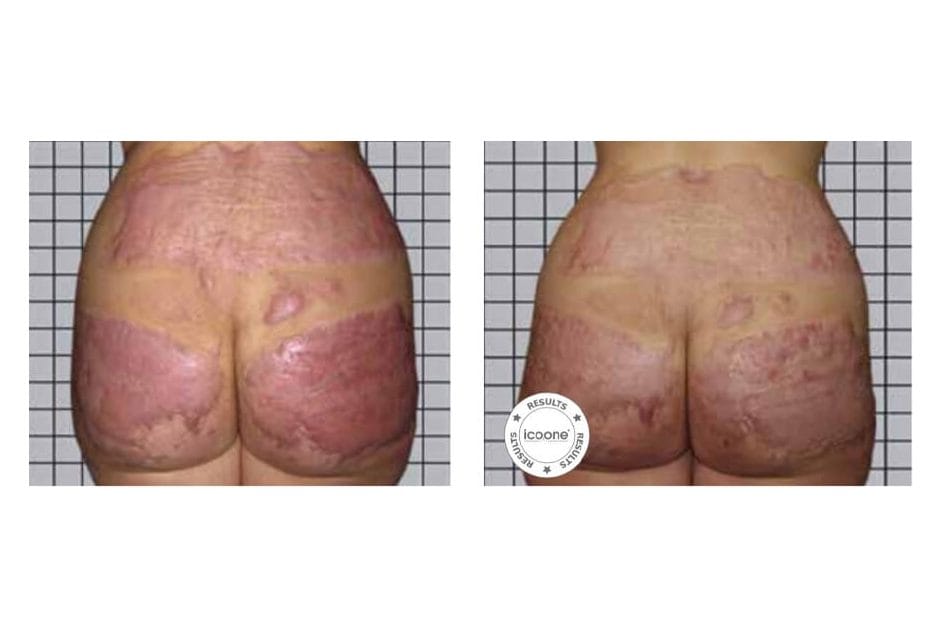 ICOONE before and after &middot; Scars, burns & fibrosis