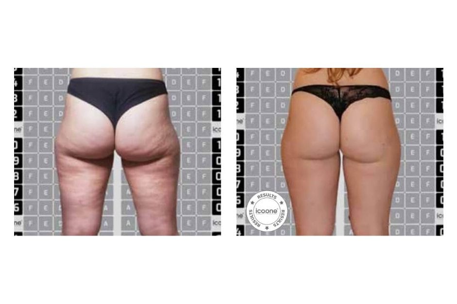 ICOONE before and after &middot; Body / cellulite