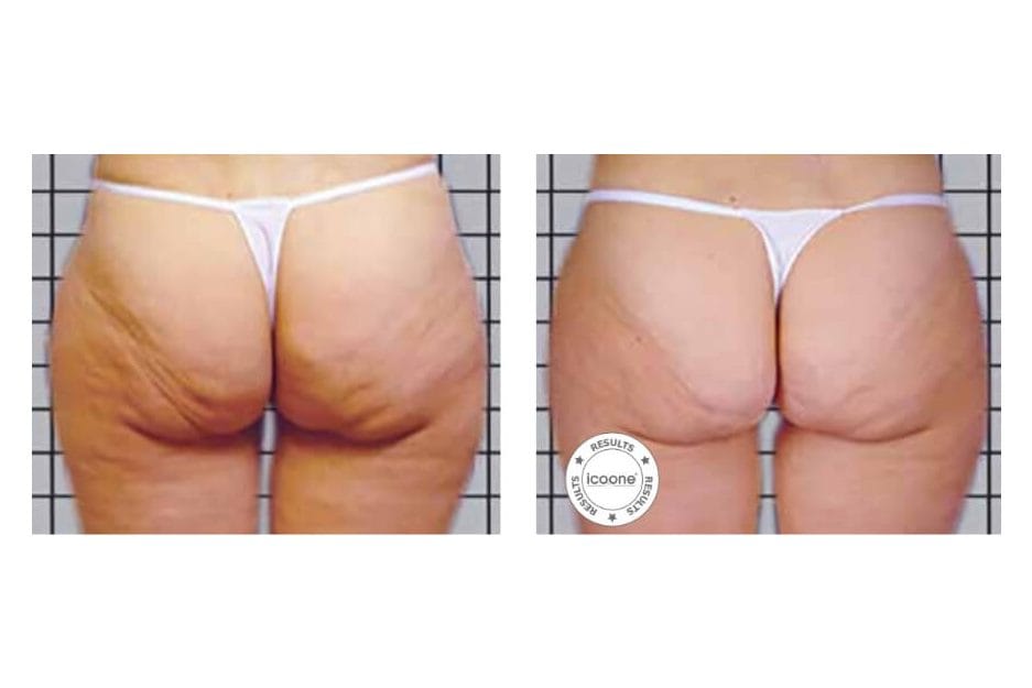 ICOONE before and after &middot; Body / cellulite