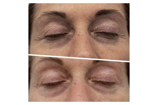 ICOONE before and after &middot; Under-eyes / de-puffing