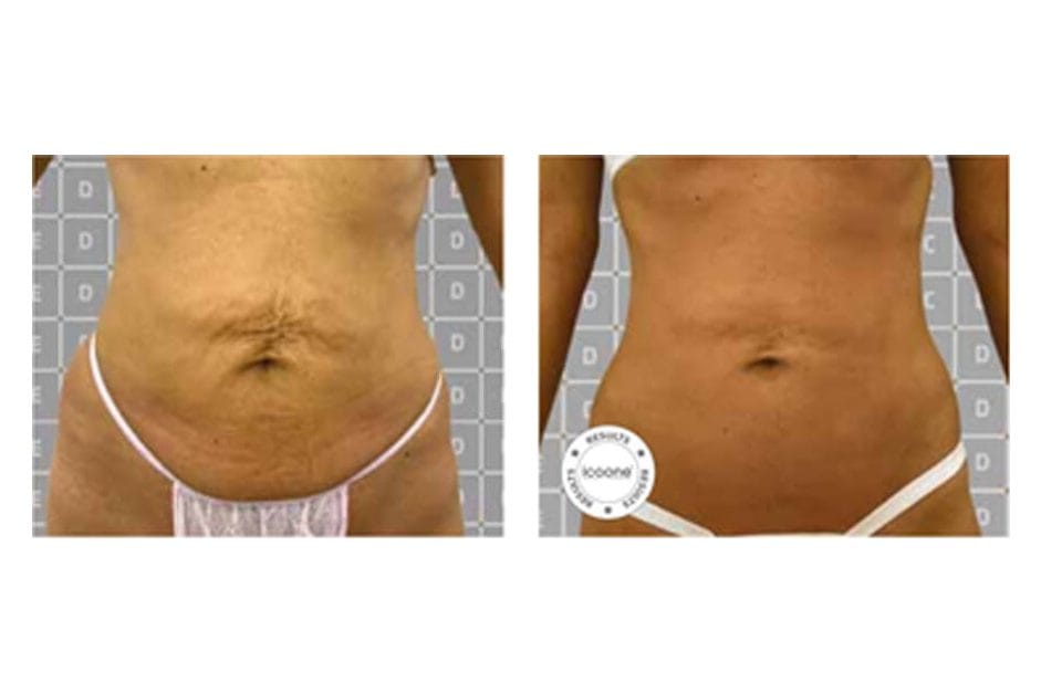 ICOONE before and after &middot; Body / firming