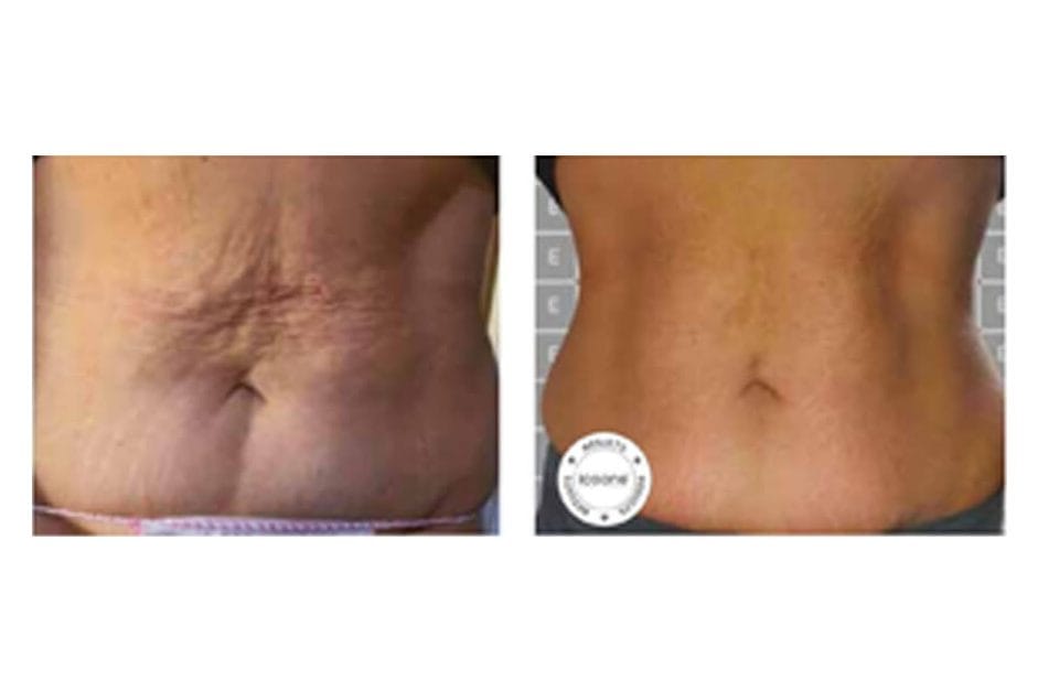 ICOONE before and after &middot; Body / firming