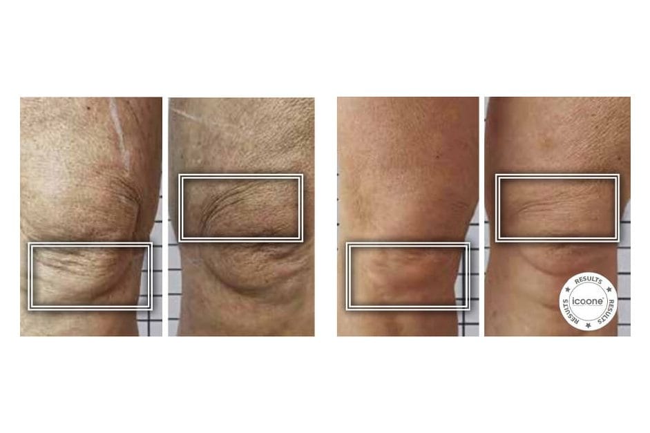 ICOONE before and after &middot; Knees / firming