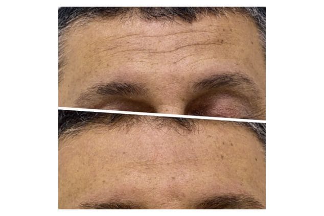 ICOONE before and after &middot; Forehead / lifting
