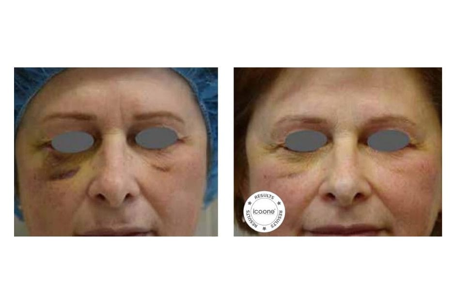 ICOONE before and after &middot; Post-surgical recovery