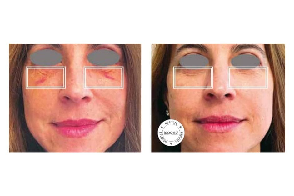 ICOONE before and after &middot; Post-surgical recovery