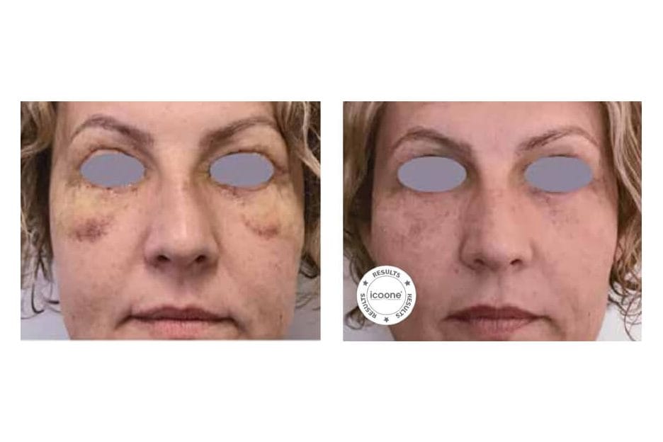 ICOONE before and after &middot; Post-surgical recovery