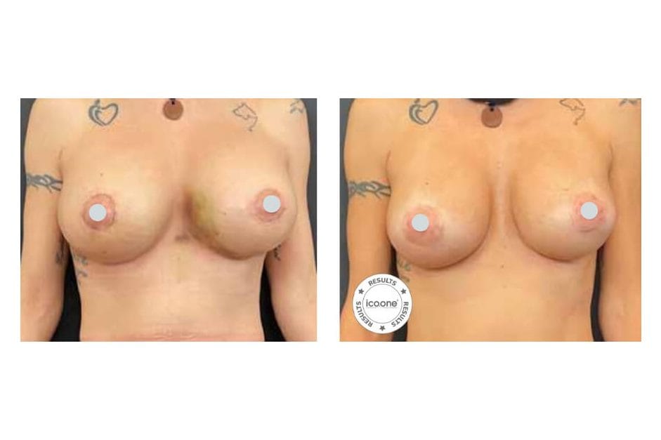 ICOONE before and after &middot; Post-surgical recovery