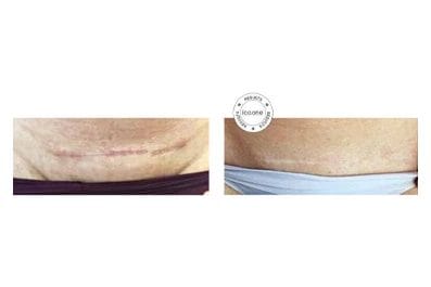 ICOONE before and after &middot; Post-surgical recovery