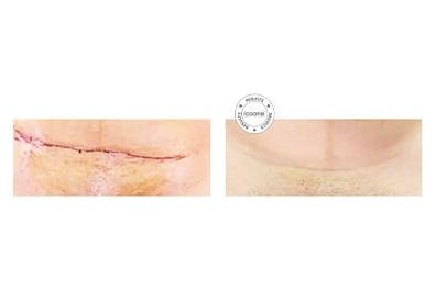 ICOONE before and after &middot; Post-surgical recovery