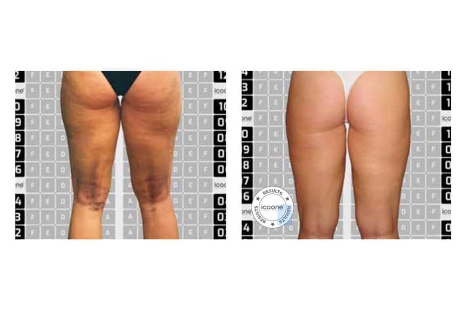 ICOONE before and after &middot; Post-surgical recovery