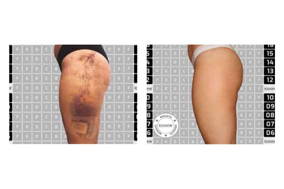 ICOONE before and after &middot; Post-surgical recovery