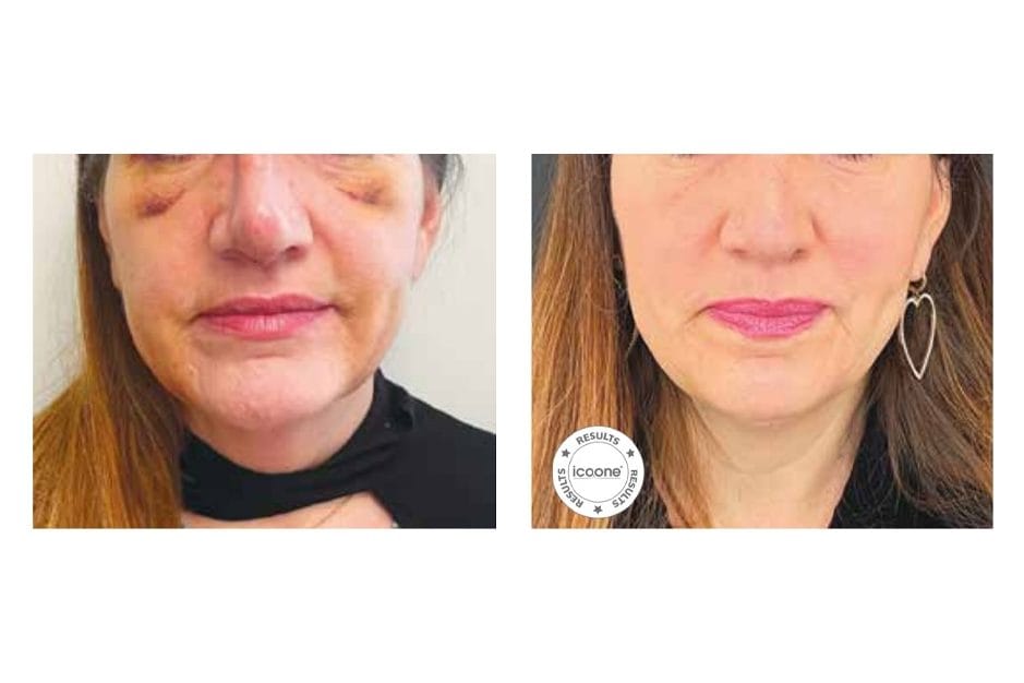 ICOONE before and after &middot; Post-surgical recovery