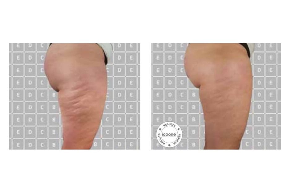 ICOONE before and after &middot; Thigh / fibrosis & cellulite