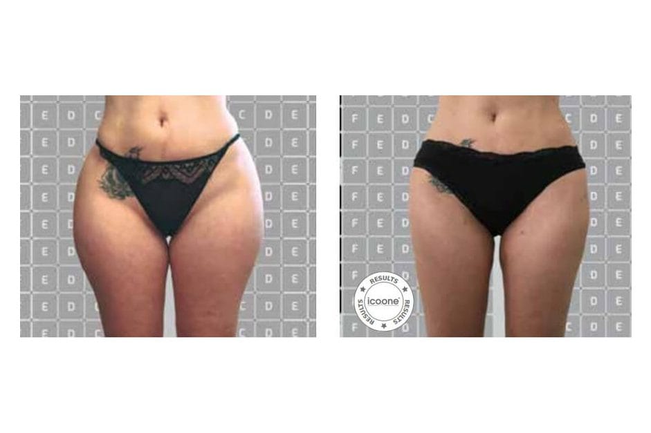 ICOONE before and after &middot; Body / remodelling