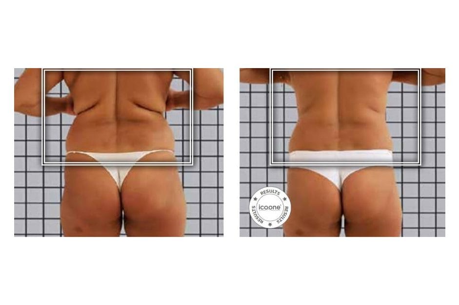 ICOONE before and after &middot; Body / remodelling