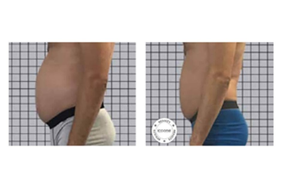 ICOONE before and after &middot; Body / remodelling