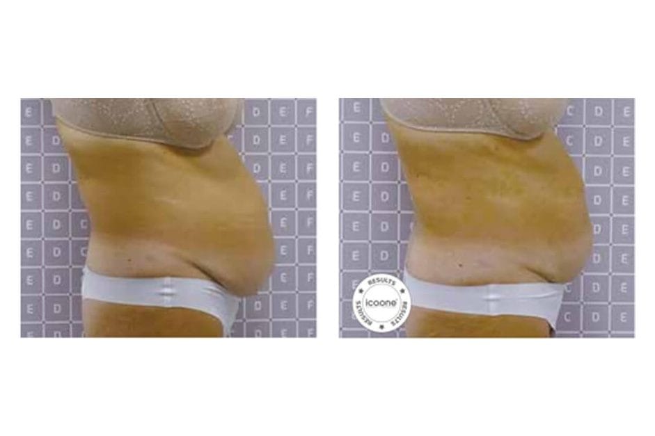 ICOONE before and after &middot; Body / remodelling