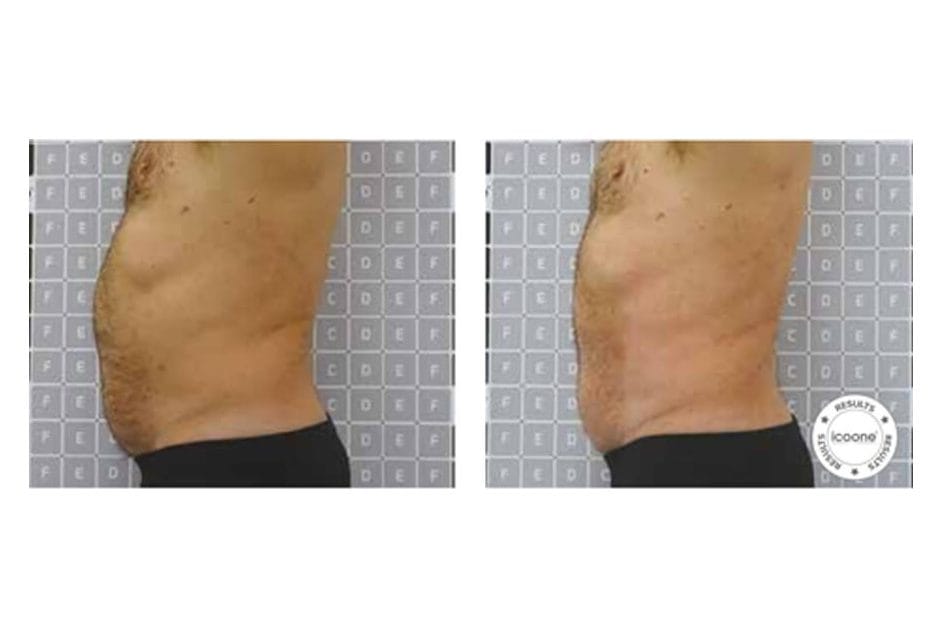 ICOONE before and after &middot; Body / remodelling