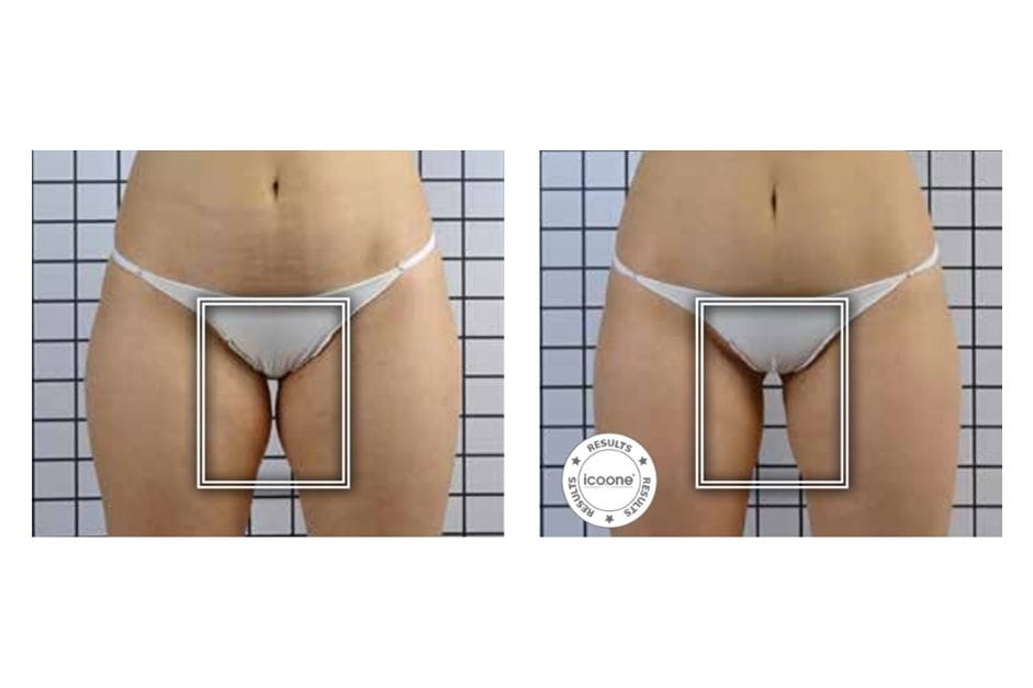 ICOONE before and after &middot; Body / remodelling