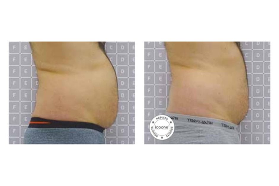 ICOONE before and after &middot; Body / remodelling