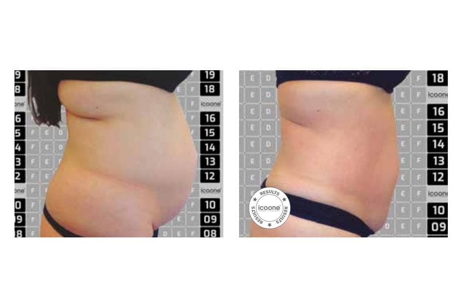 ICOONE before and after &middot; Body / remodelling