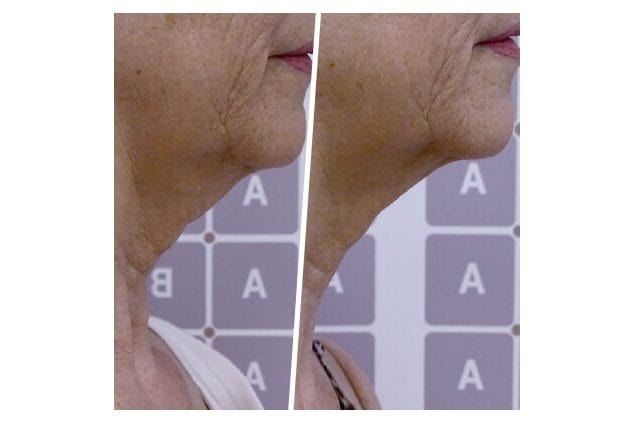 ICOONE before and after &middot; Neck & jawline / remodelling