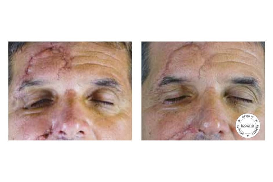 ICOONE before and after &middot; Scars, burns & fibrosis