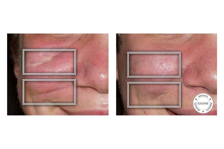 ICOONE before and after &middot; Scars, burns & fibrosis
