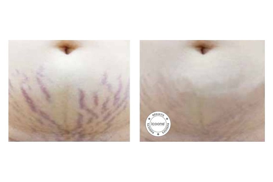 ICOONE before and after &middot; Body / stretch marks