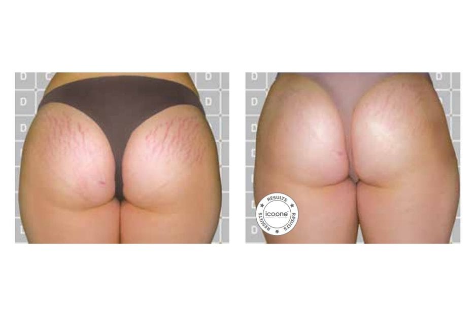 ICOONE before and after &middot; Body / stretch marks