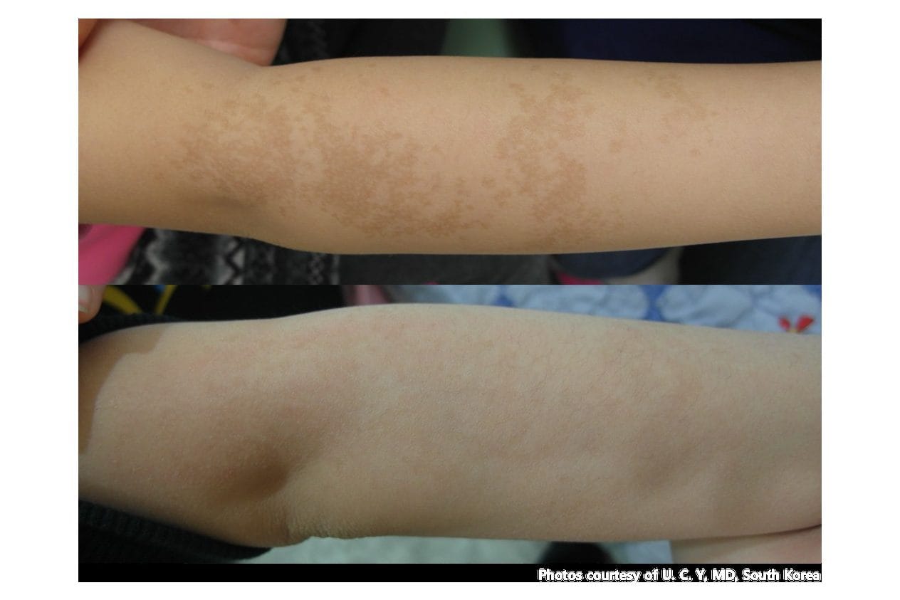 NouvaDerm before and after &middot; Arm / cafe au lait