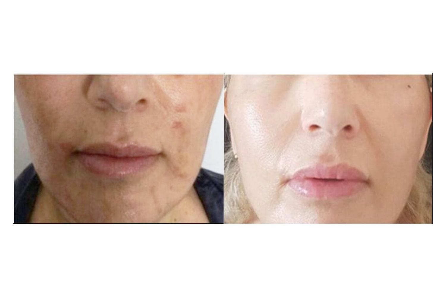 NouvaDerm before and after &middot; Perioral / lines