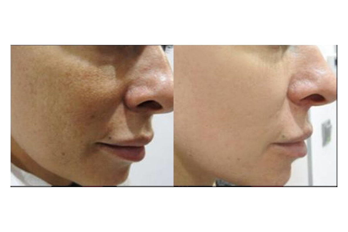 NouvaDerm before and after &middot; Face / pigmentation