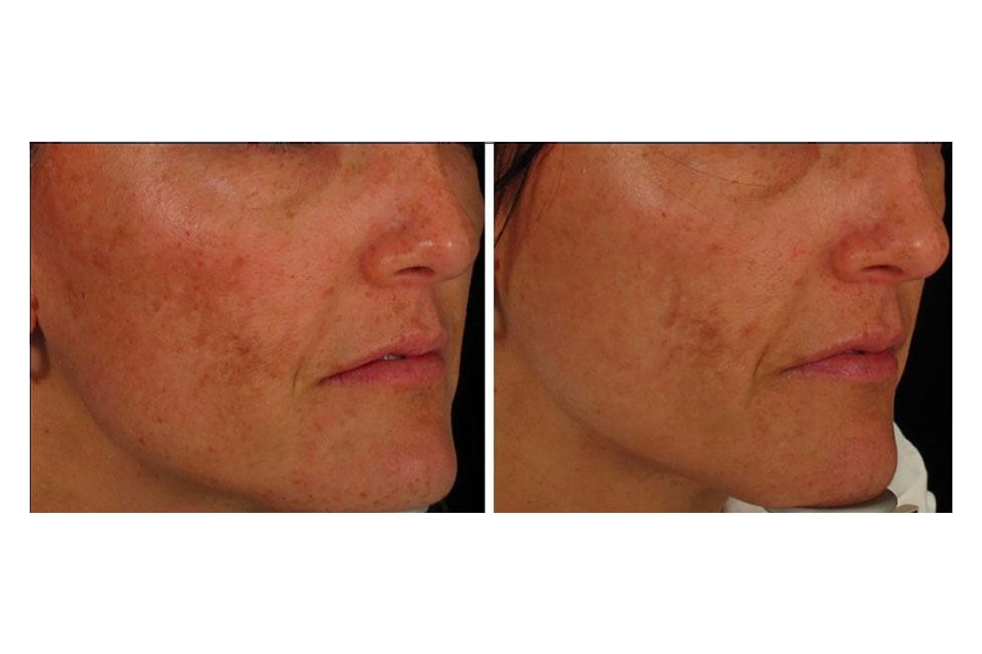 NouvaDerm before and after &middot; Face / redness & pigmentation
