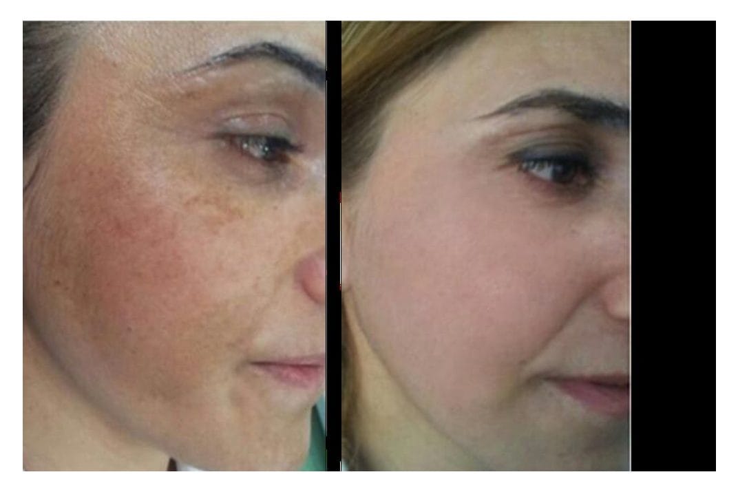 NouvaDerm before and after &middot; Face / redness & melasma