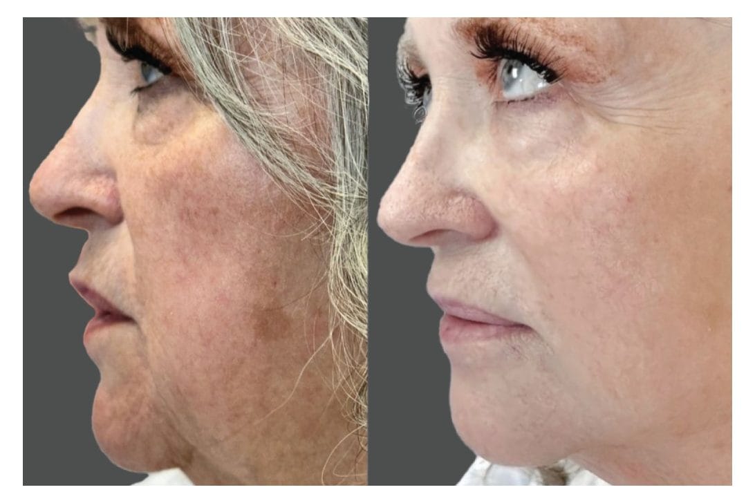 NouvaDerm before and after &middot; Face / sun damage