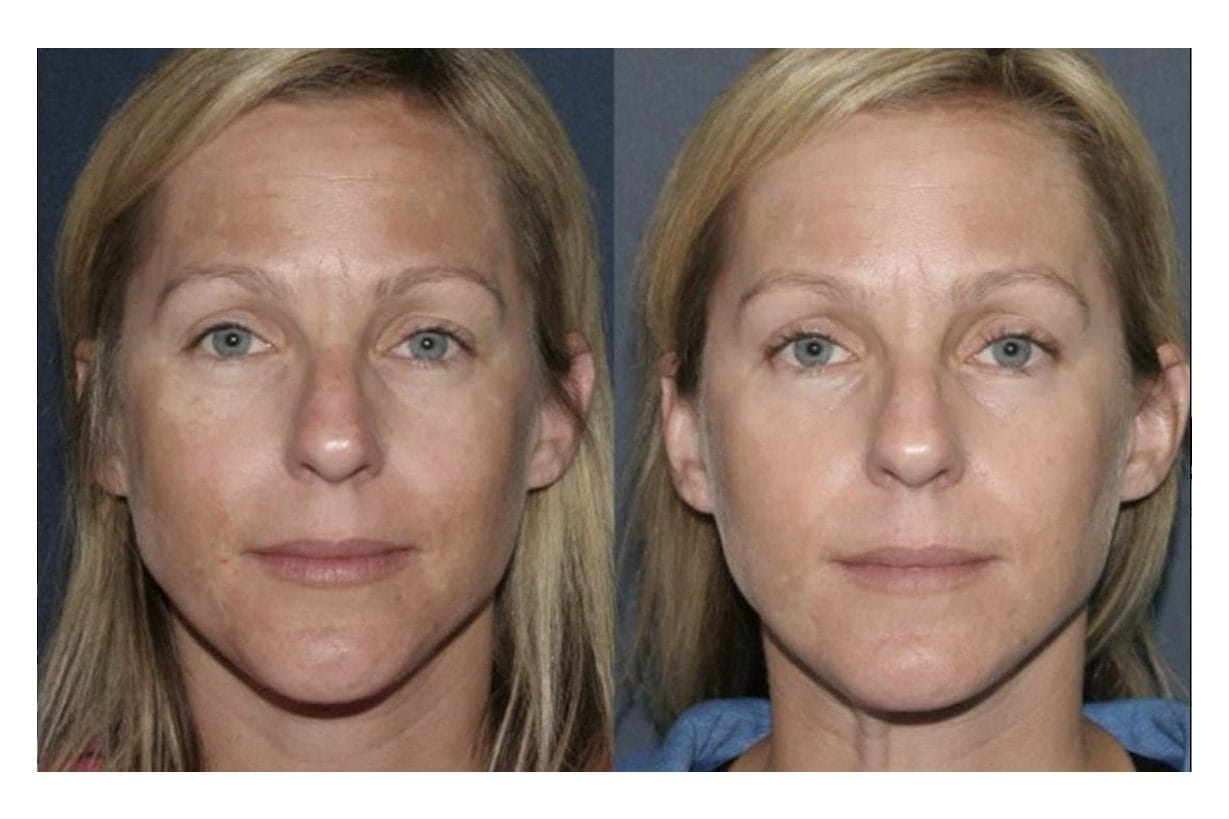 NouvaDerm before and after &middot; Face / sun damage