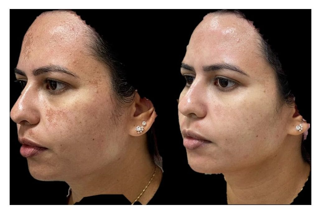 NouvaDerm before and after &middot; Face / tone