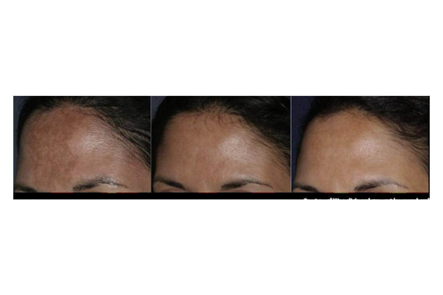 NouvaDerm before and after &middot; Forehead / melasma