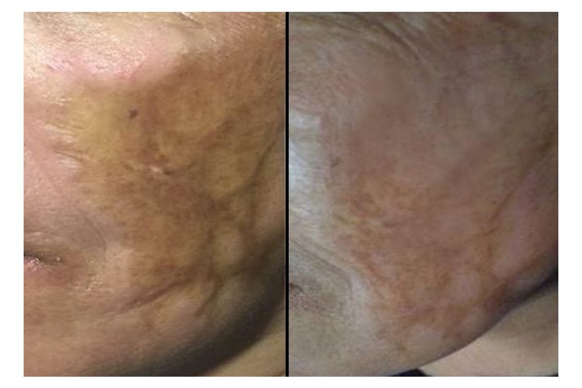 NouvaDerm before and after &middot; Neck / texture & pigmentation