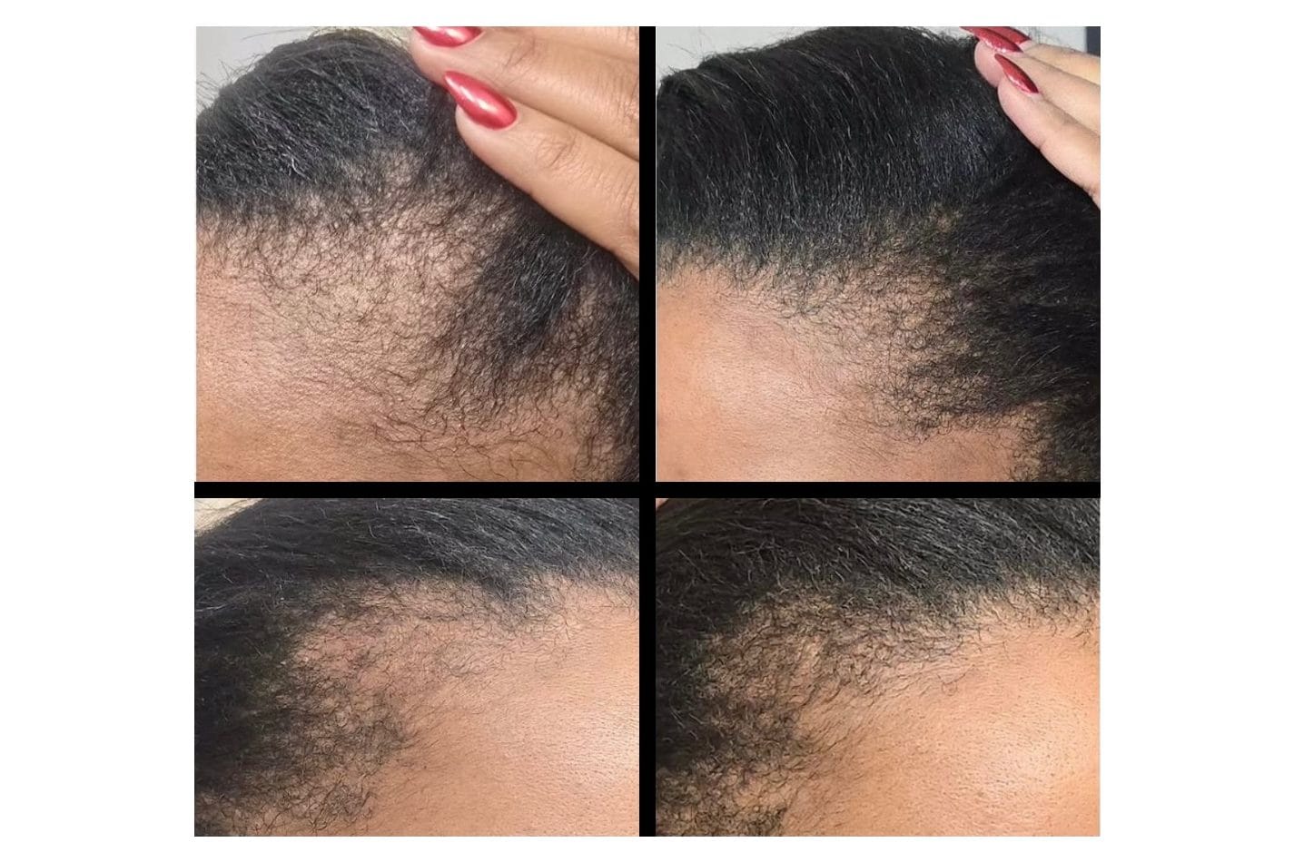 NouvaDerm before and after &middot; Scalp / hairline