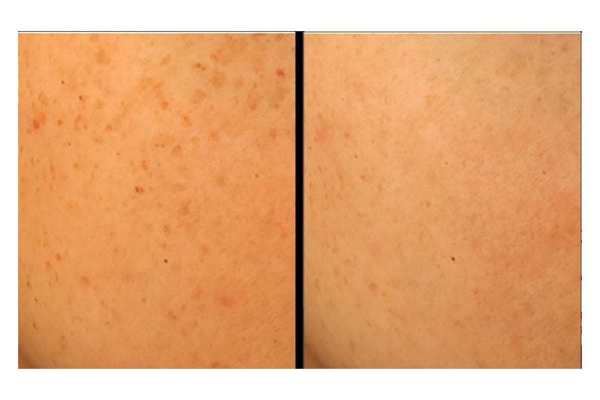 NouvaDerm before and after &middot; Skin / sun spots