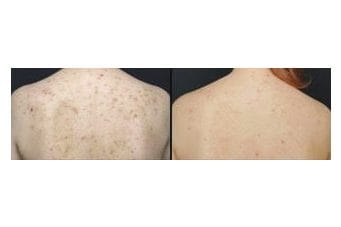 PLADUOpro before and after &middot; Back / acne