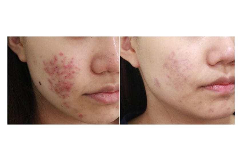 PLADUOpro before and after &middot; Face / acne