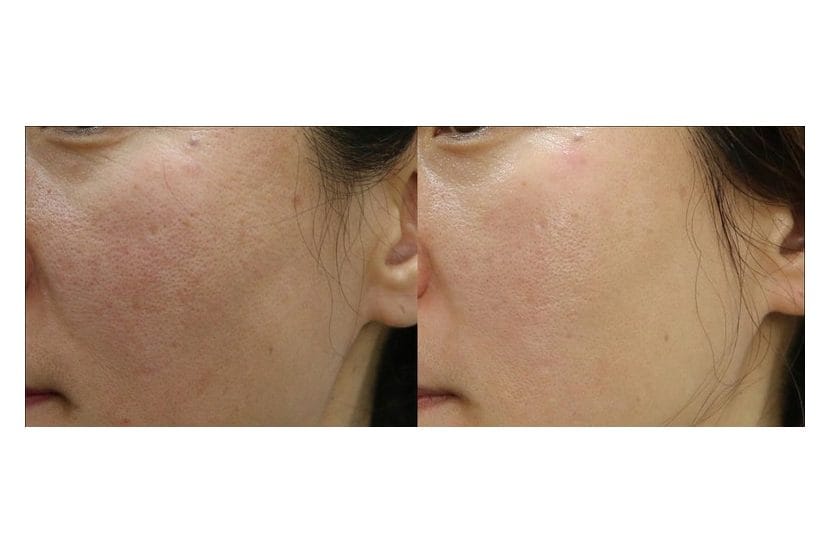 PLADUOpro before and after &middot; Face / texture & pores